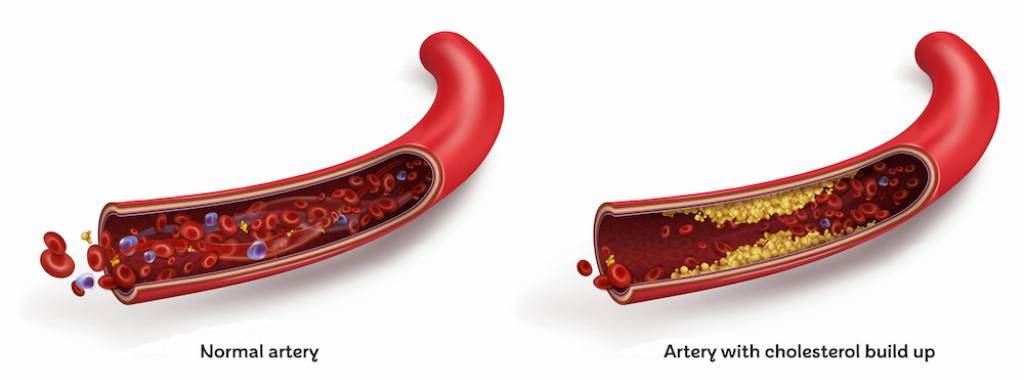 The Silent Killer Affecting 40% of Adults in the UK arterychol.png